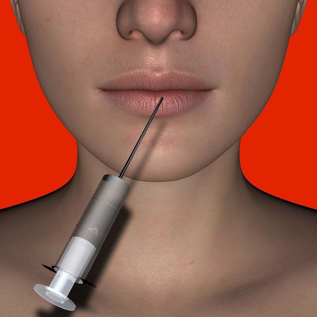 dermal lip filler photo